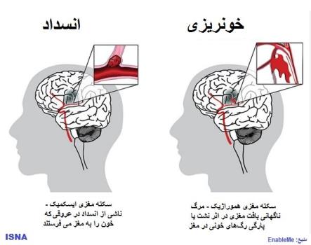 اصلی ترین عامل خطر سکته مغزی در همه کشورها